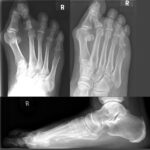 hallux valgus