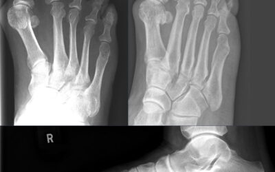 hallux valgus