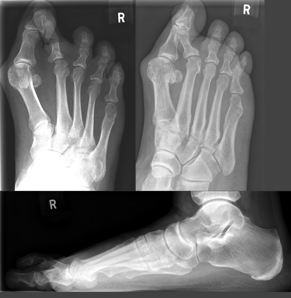 hallux valgus